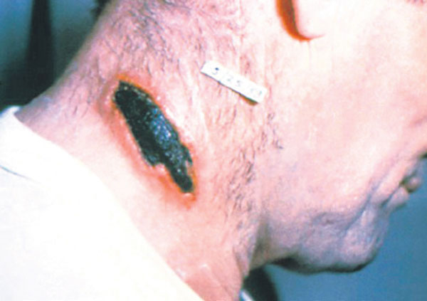 TƏCİLİ: Azərbaycanda qarayara xəstəliyi yayıldı