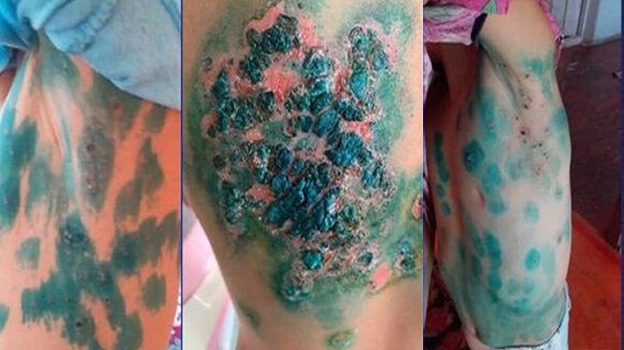 Nazirlikdən Balakəndə yayılan naməlum xəstəliklə bağlı - Açıqlama