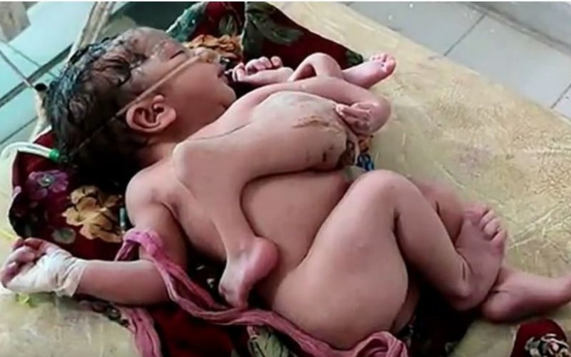 Dörd ayaqlı, üç əlli körpə doğuldu – FOTO