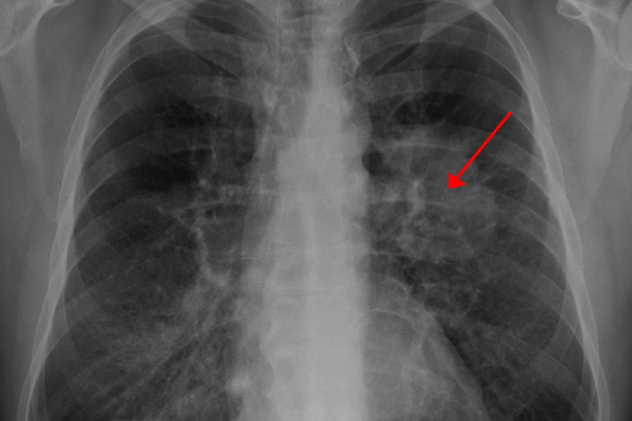 Bu əlamətlər varsa, ağ ciyər xərçəngindən ŞÜBHƏLƏNİN