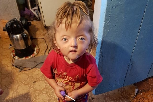 Девочке с деформированным черепом из Башкирии не сделают операцию на голову