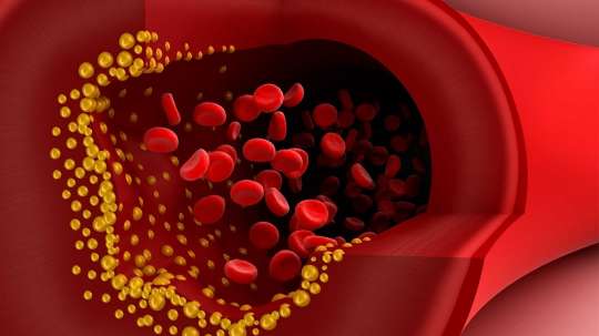 Damar tıxanmasına və insulta səbəb olan QİDALAR