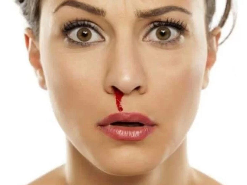 Burun qanaması nədən xəbər verir? - Səbəbləri və müalicəsi