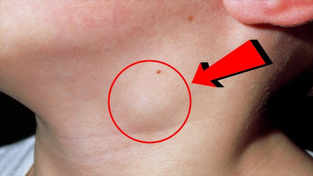 Limfa düyünləri şişən şəxslərdə bu qorxunc xəstəliklər var