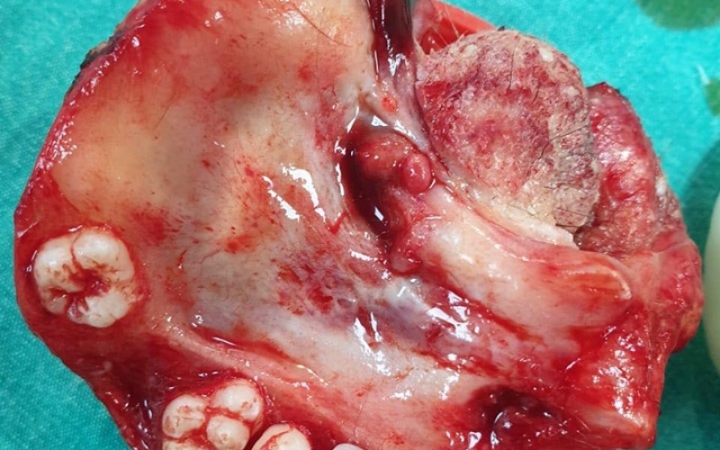 19 yaşlı qızın yumurtalığından çənə sümüyü çıxdı – Azərbaycanda ŞOK 