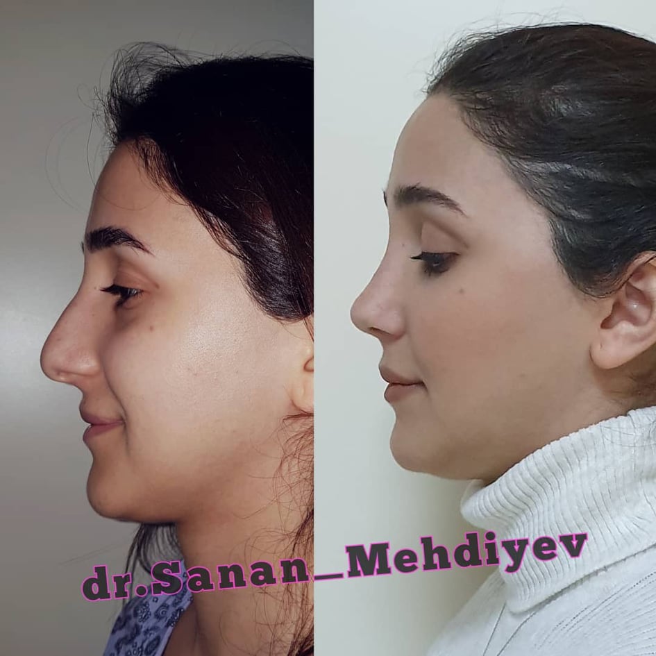 Burun əməliyyatı etdirərkən bunlara diqqət edin!Plastik cərrah Sənan Mehdiyev AÇIQLADI +FOTOLAR