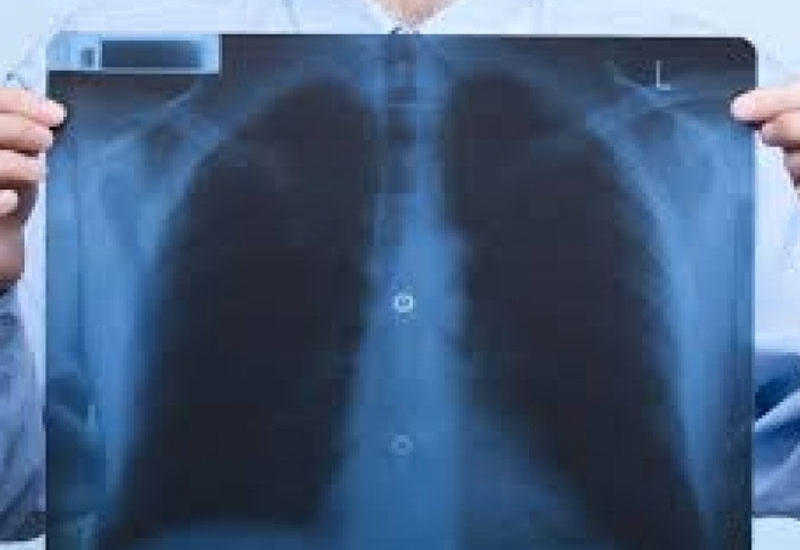 Gizli pnevmoniyanın ilk 6 əlaməti - Dərhal həkimə müraciət edin