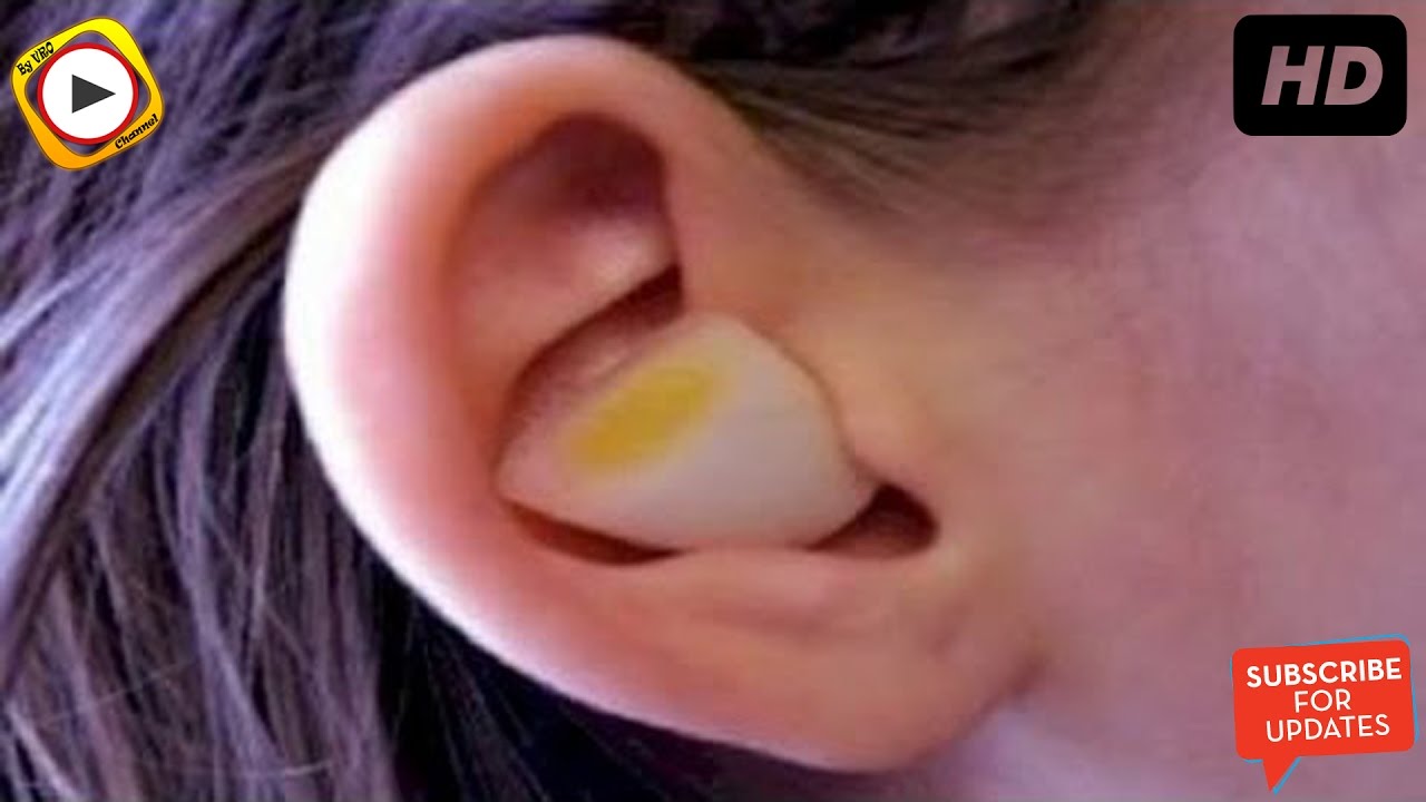 Qulağa soğan parçası qoymaq görün nələr edir ? - VİDEO