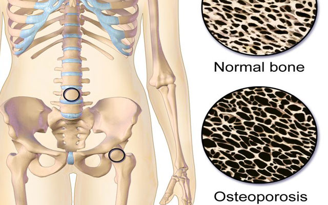 Sümük kütləsinin azalması - OSTEOPOROZ. Səbəblər, simptomlar, müalicə