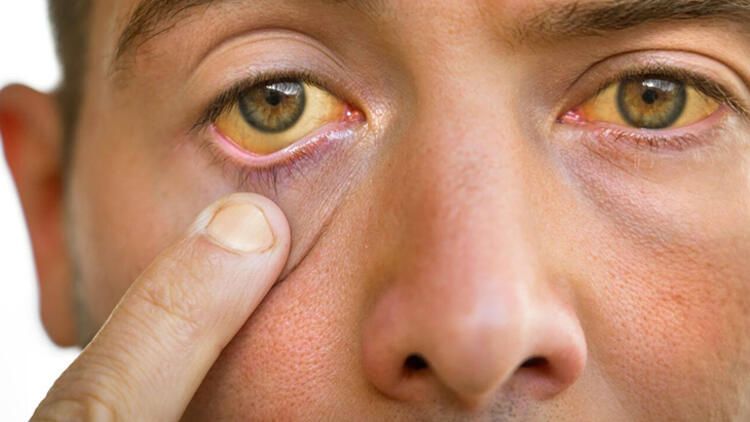 Gözlərinizin ağı saralıbsa, BU XƏSTƏLİKDƏN  şübhələnmək lazımdır