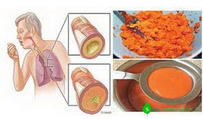 Bu  vasitə ilə, ən ağır öskürək və qrip 24 saata sağalacaq, ağciyəri anında təmizlənəcək!