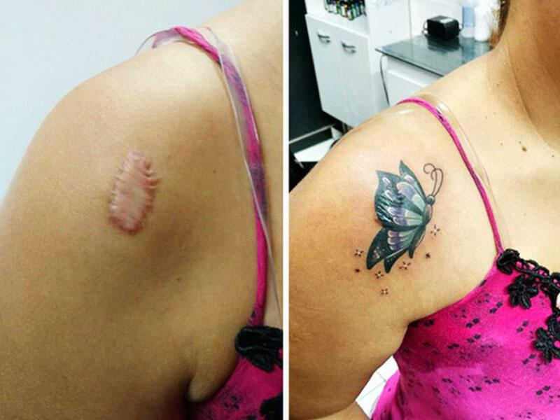 Onlar TATUNU niyə döydürür? - Ləkə, yara, çapıq...