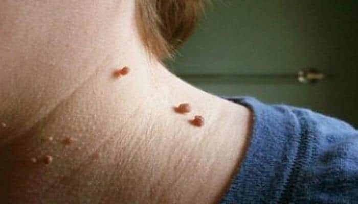 Hansı ət xallar xərçəngə çevrilə bilər?