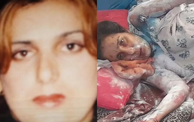 Qayınatası tərəfindən üzünə “kislota” töküldüyü deyilən qadın öldü