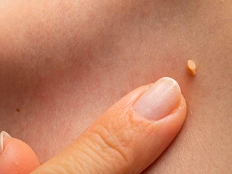 İnsan papilloma virusu nədir?