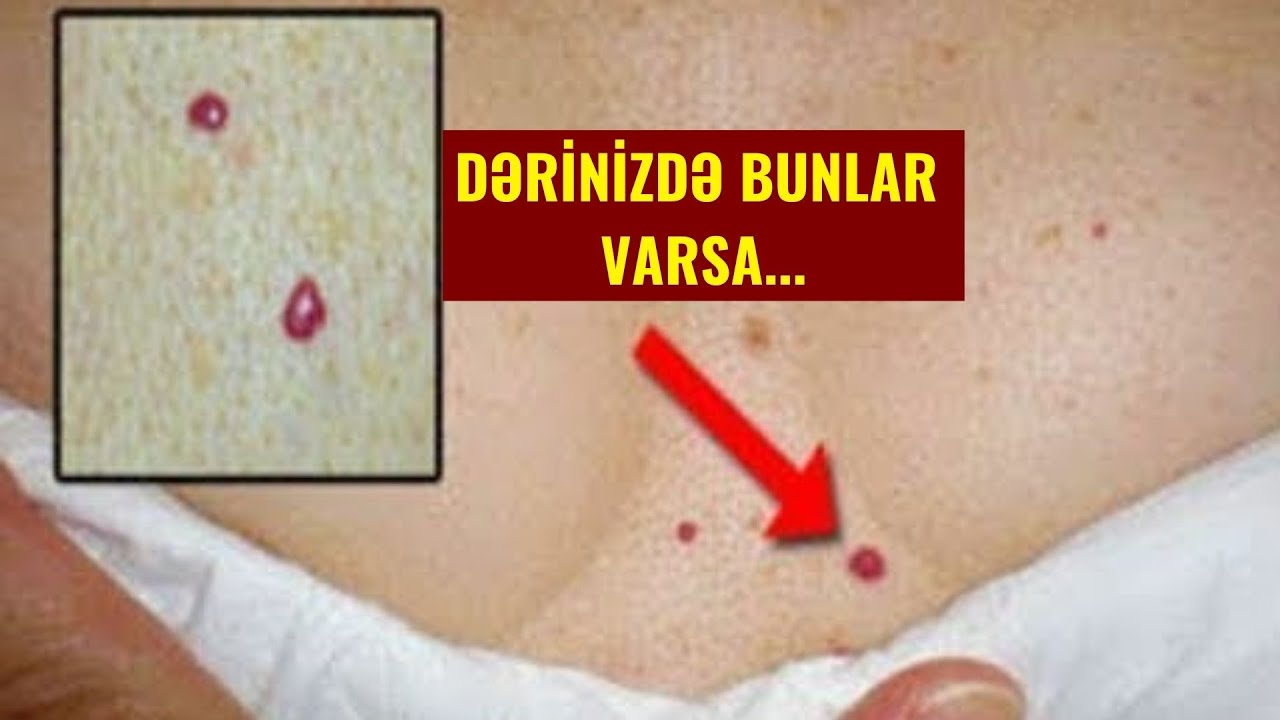 DİQQƏT!!! sizdə bu 10 əlamətdən biri varsa, Ürəyiniz düz işləmir (VİDEO)