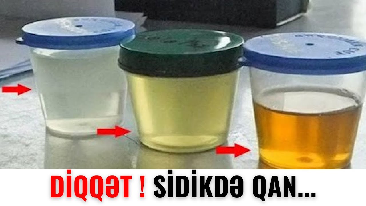 Sidikdə qan bu xəstəliyin əlamətidir - MÜTLƏQ İZLƏ