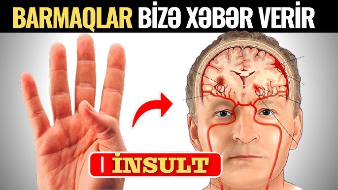 İnsultu Barmaqla Öncədən Biliblər - Paralicin Əlamətləri