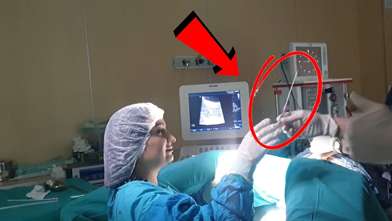 Şok əməliyyat görüntüsü - Süni mayalanma belə edilir!