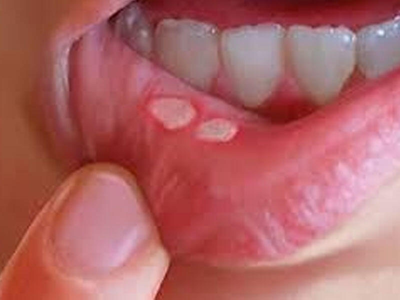 Ağız içində ağrılı yaralar bu vitamin əskikliyindəndir