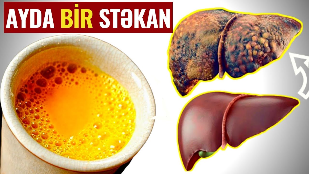 Qaraciyərin zəhərləndiyini göstərən 16 VACİB ƏLAMƏT