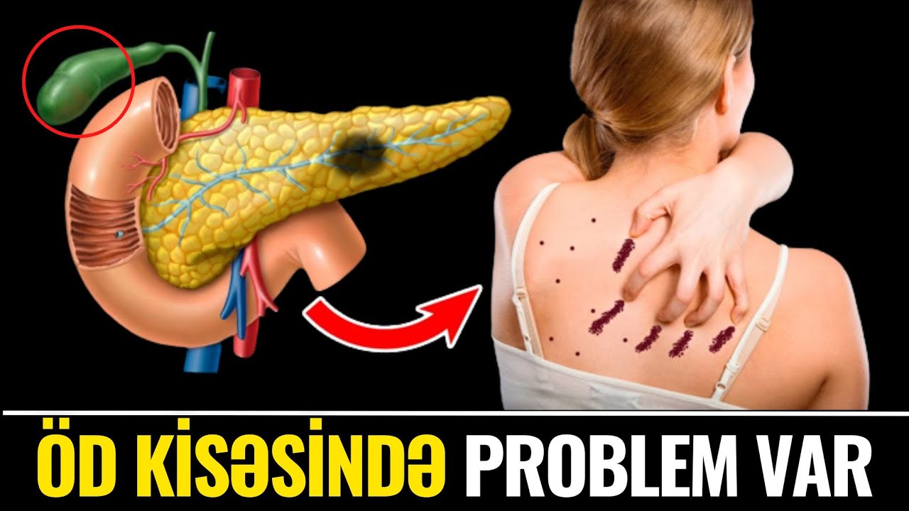 Öd Kisəsinin Məhv Olduğunu Göstərən 7 VACİB ƏLAMƏT