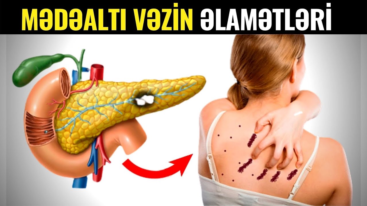 Mədəaltı Vəzin Xəstə Olduğunu Göstərən Əlamətlər +VİDEO