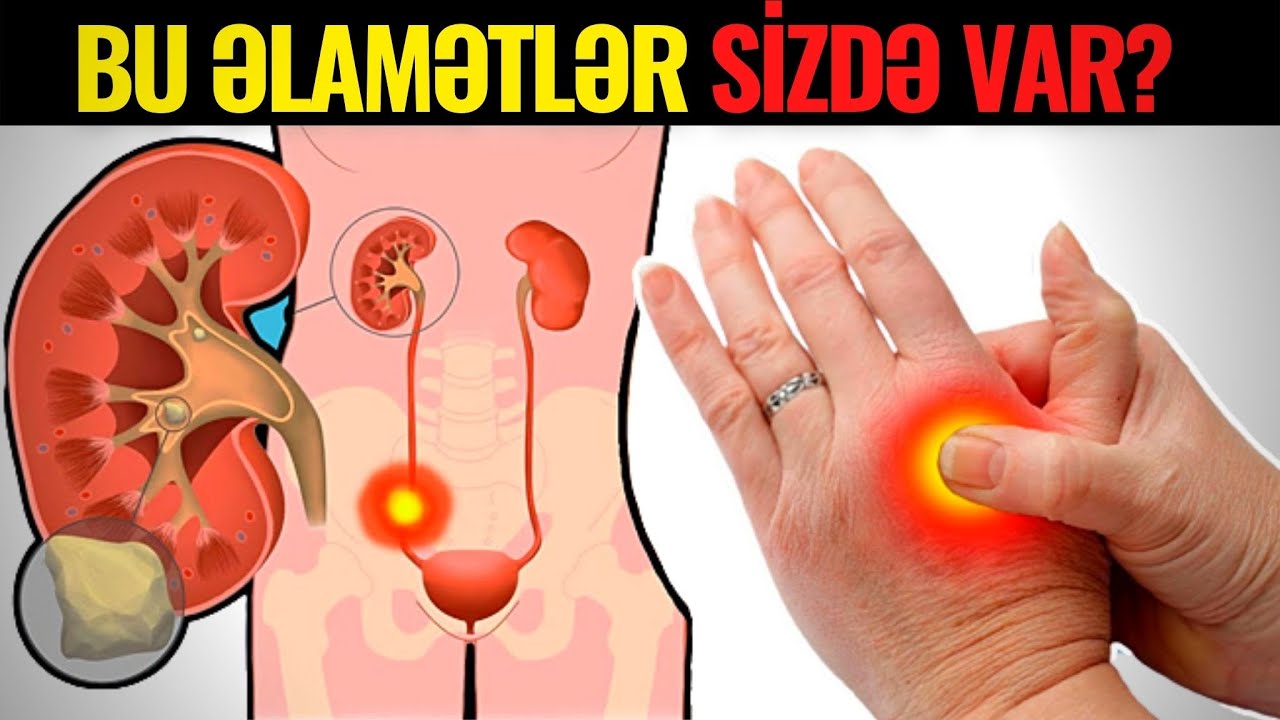 Böyrəkdə Problem Varsa - Bu 10 Əlamət Olur