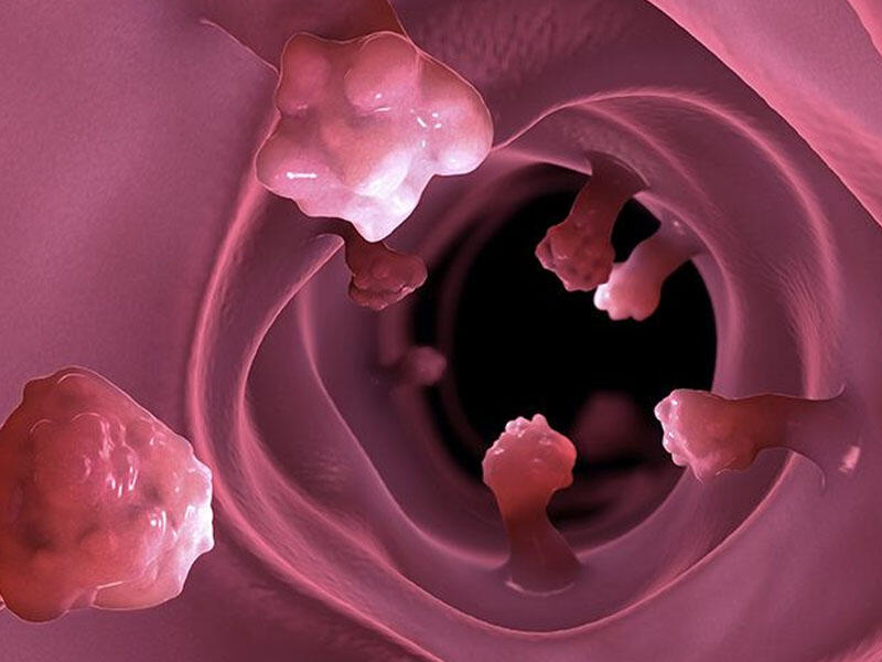 Bağırsaqlarda polip və adenomalar TƏHLÜKƏLİDİR?