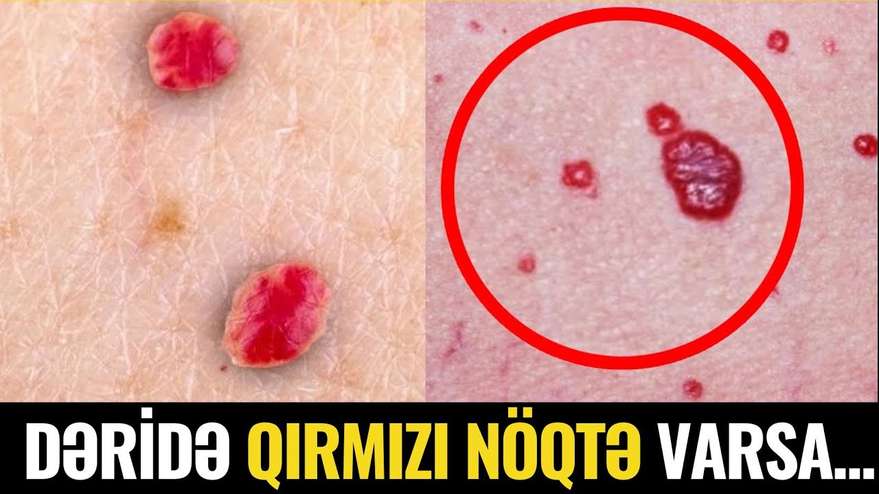 Bədəndə QIRMIZI NÖQTƏLƏR Niyə Təhlükəlidir?- VİDEO