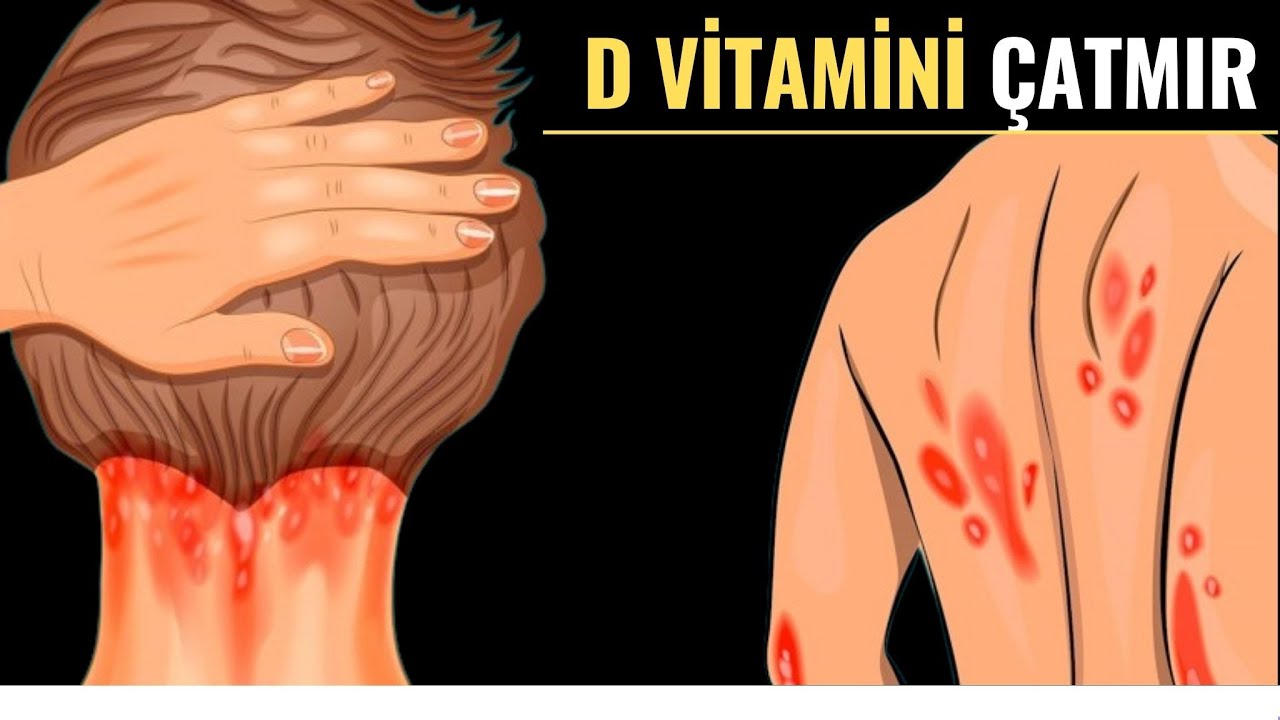D vitamini çatışmazlığının vacib əlamətləri BUNLARDIR