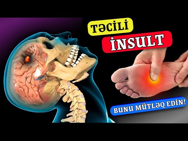 Yaxınlaşan İnsultun 8 ƏLAMƏTİ - Bədən Xəbərdarlıq Edir