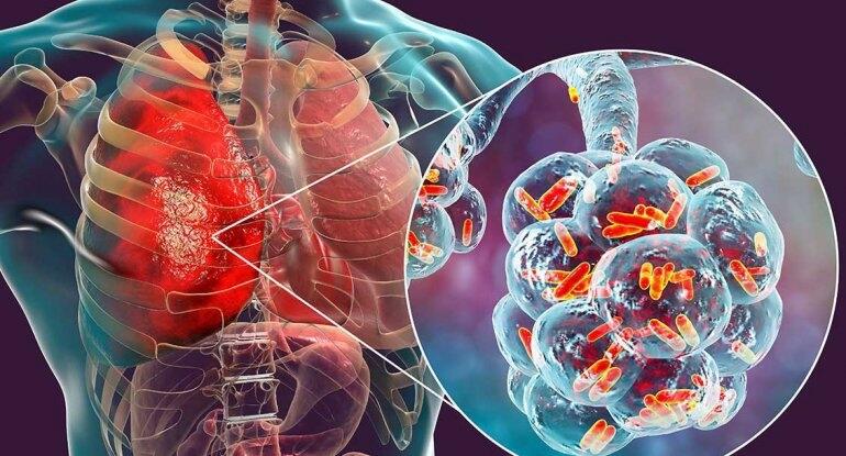 Hovuz və kondisionerlər vasitəsi ilə dəhşətli virus yayılır - 50 yaşdan yuxarı...