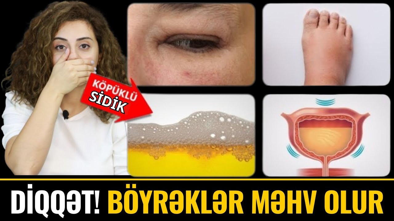 Böyrəklərin Öldüyünü göstərən 10 VACİB ƏLAMƏT