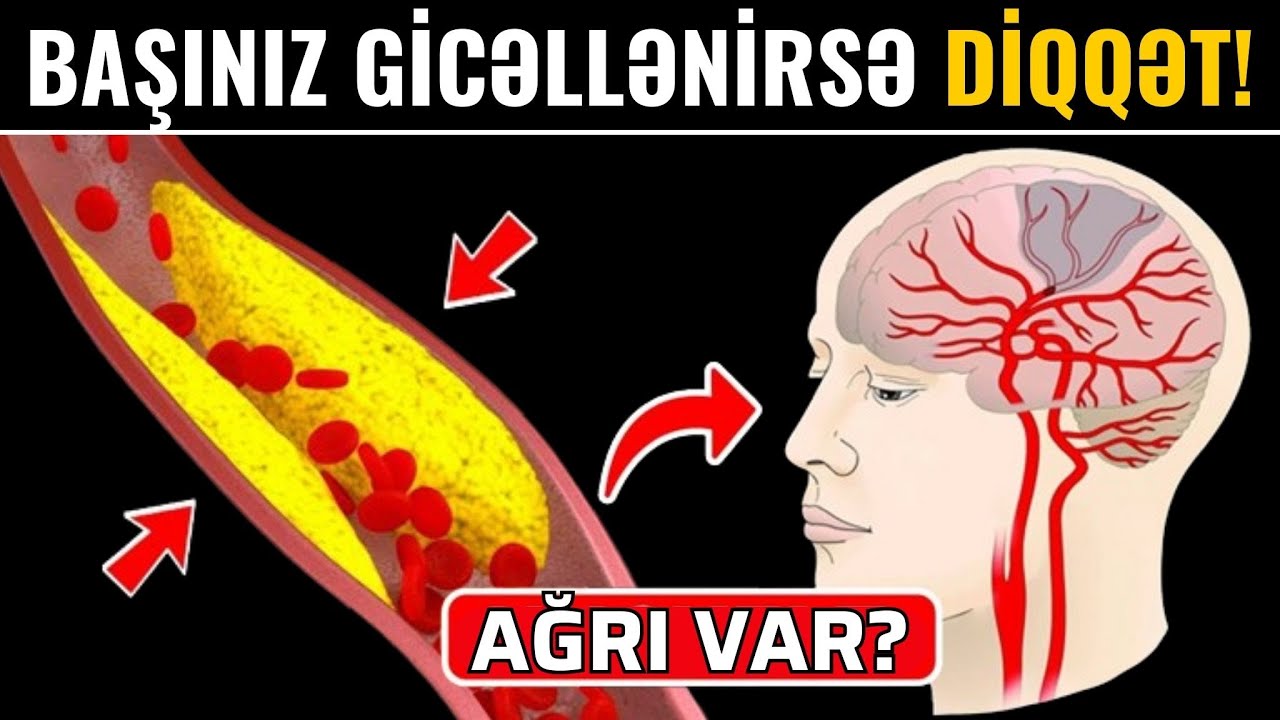 Başgicəllənmə görün hansı xəstəliklərin əlamətidir  -  DİQQƏT!