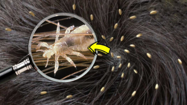 Saç bitini bu yolla təmizləmək mümkündür&nbsp;