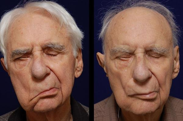 Üst siniri iflici necə müalicə olunur?