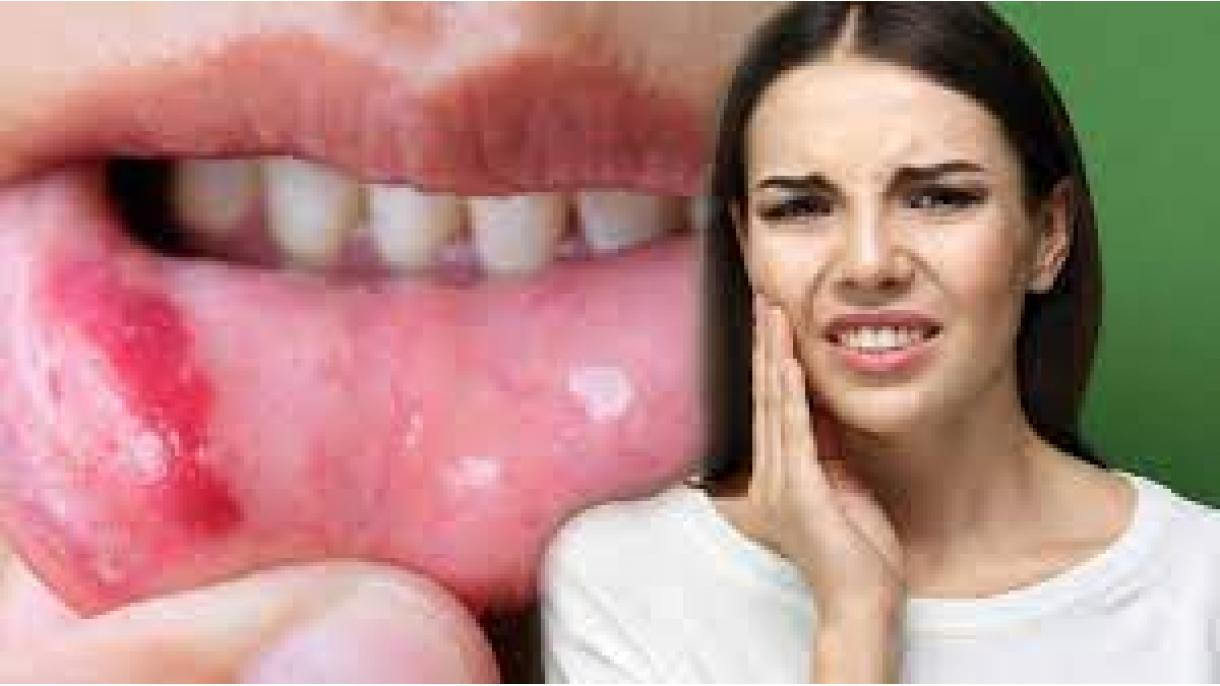 Ağız yaraları ilə bağlı qorxunc XƏBƏRDARLIQ