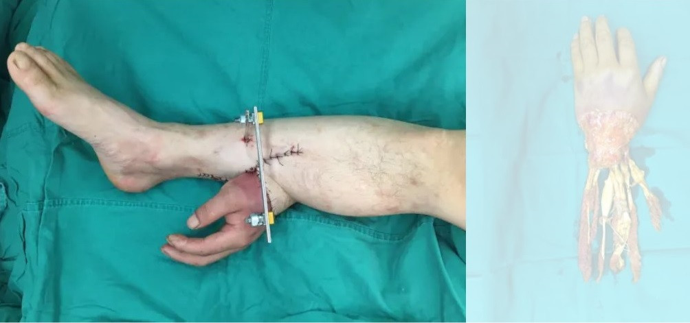 Qopan əli ayağa tikdilər&nbsp;