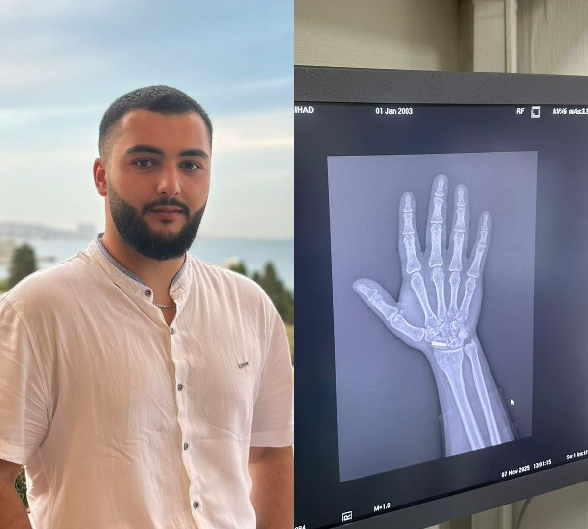 Qolunda \"mil\" olan gəncin hərbi xidmətə çağırılması ilə bağlı xəbərə RƏSMİ AÇIQLAMA + HÜQUQŞÜNAS MÖVQEYİ&nbsp;&nbsp;