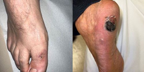 Kapoşi sarkoması nədir?