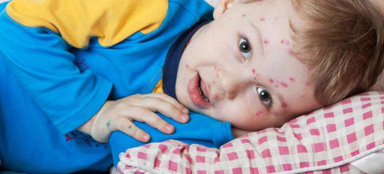 Suçiçəyi ilə bağlı vacib tövsiyə! Bunu etməyin - Həkim AÇIQLADI