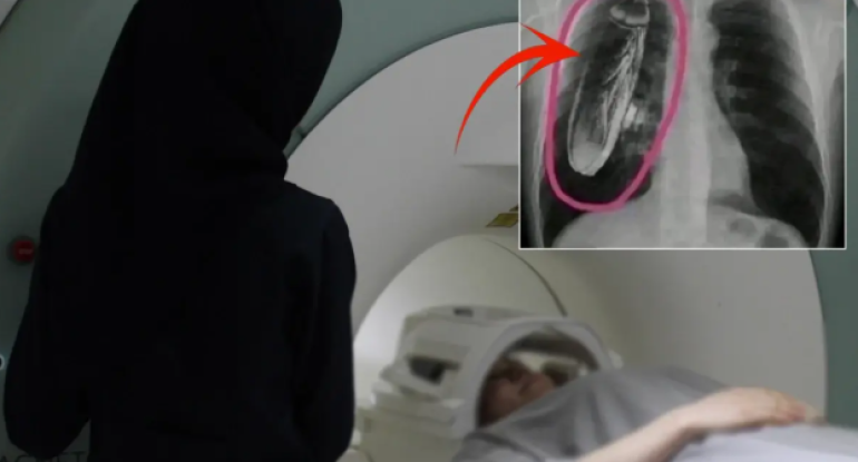 Bədənində \"canlı tarakan var\" dedilər, həqiqət isə başqa imiş - FOTO  