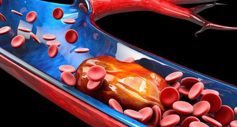 Damarlarımızı içəridən nə zədələyir?&nbsp;&nbsp;