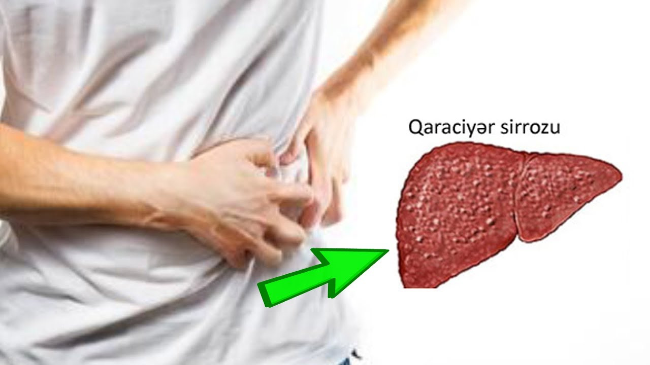 Sirroz necə yaranır və niyə təhlükəlidir? –    Mütəxəssis açıqlayır&nbsp;&nbsp;