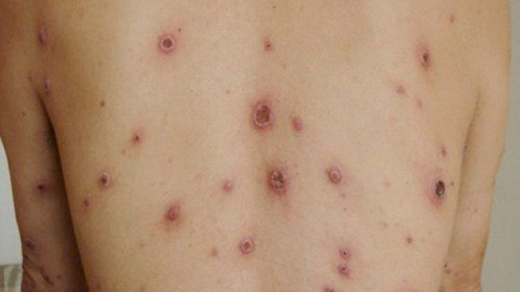 Siflis necə müalicə olunur?    —   HƏKİM AÇIQLADI