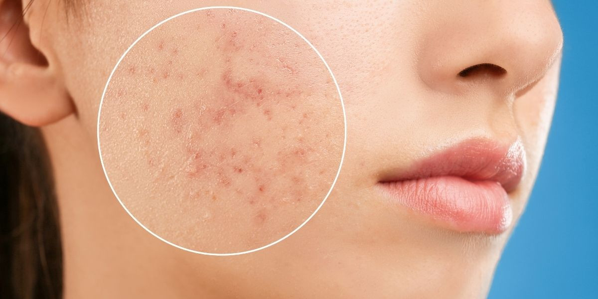 Akne nə zaman yaranır?