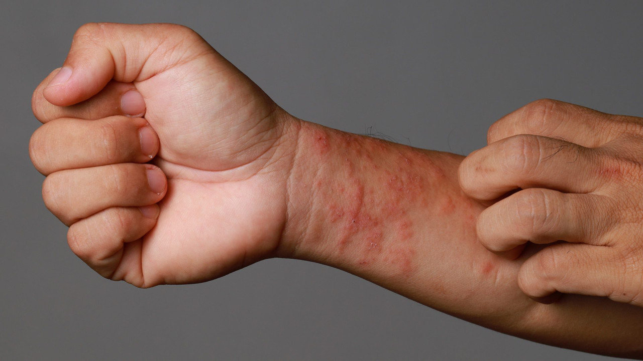 Ekzema zamanı&nbsp; dəriyə qulluq&nbsp; NECƏ EDİLMƏLİDİR?