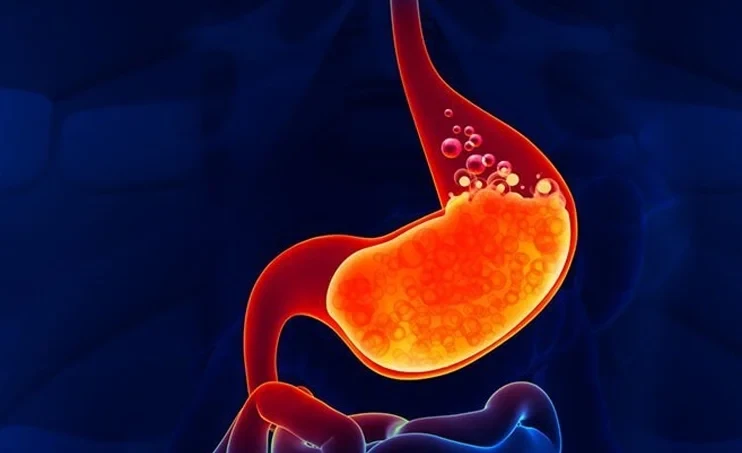 Reflüks xəstəliyi öskürəyə səbəb ola bilərmi?&nbsp; &nbsp;