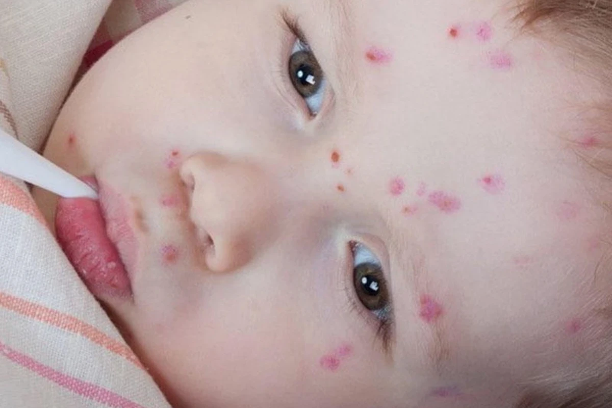 Qızılca ilə bağlı pediatr XƏBƏRDARLIQ EDİR